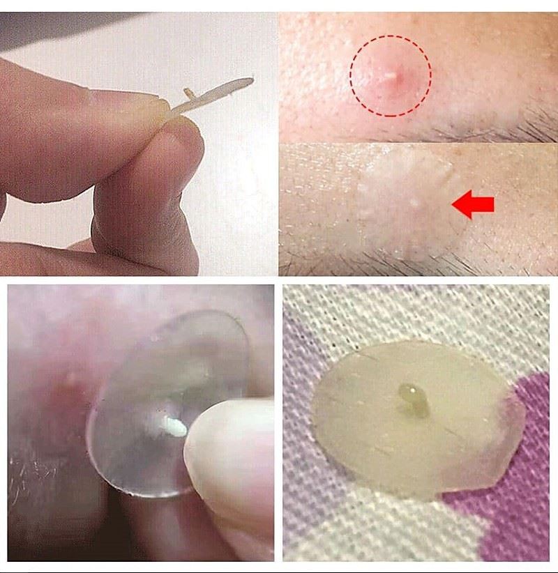 pimple patches how to use pimple patches how to use